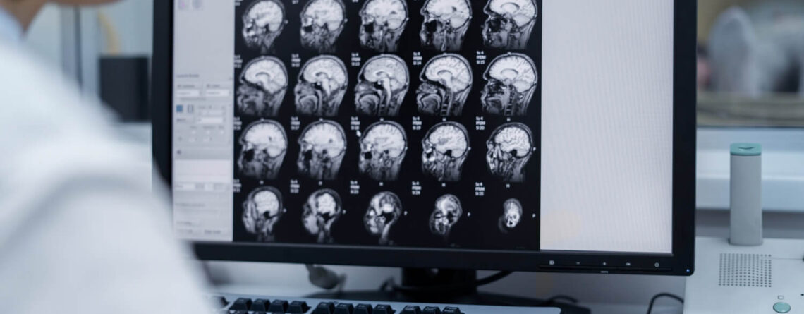 Pilocytic astrocytoma Pilocytic astrocytoma